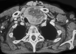 Substernal Thyroid - CTisus CT Scan