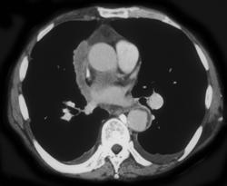 Thymoma - CTisus CT Scan