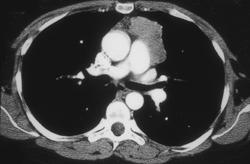 Lymphoma - CTisus CT Scan