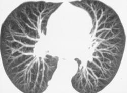 3D of the Lung - CTisus CT Scan