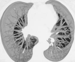 Pseudolesion in the Fissure - CTisus CT Scan