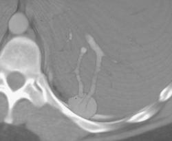 Pulmonary Arteriovenous Malformation (PAVM) - CTisus CT Scan