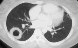 Wegener's Granulomatosis - CTisus CT Scan