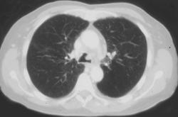 Metastases to the Trachea - CTisus CT Scan