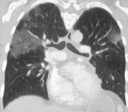 Pneumonia in 3D - CTisus CT Scan