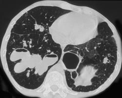 Cystic Fibrosis - CTisus CT Scan