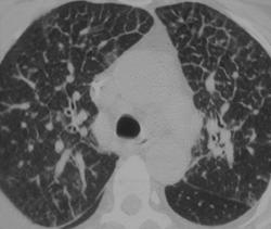 Lymphangitic Spread of Cancer - CTisus CT Scan