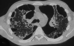 Cystic Fibrosis - CTisus CT Scan