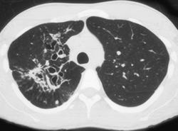 Bronchiectasis - CTisus CT Scan