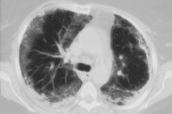 Idiopathic Pulmonary Fibrosis (IPF) - CTisus CT Scan