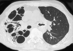 Cystic Bronchiectasis - CTisus CT Scan