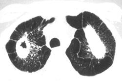 Silicosis with Tuberculosis (TB) - CTisus CT Scan