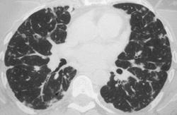 Classic Lymphatic Spread of Disease - CTisus CT Scan