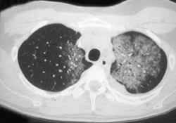 Radiation Pneumatosis - CTisus CT Scan