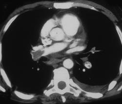 Pulmonary Embolism - CTisus CT Scan