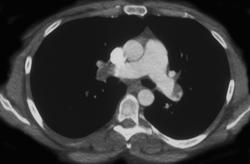 Pulmonary Embolism - CTisus CT Scan