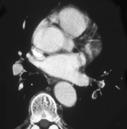 Pulmonary Embolism - CTisus CT Scan