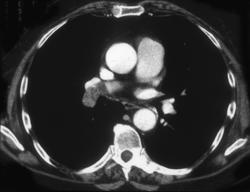 Pulmonary Embolism - CTisus CT Scan