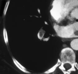 Pulmonary Embolism - CTisus CT Scan