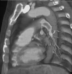 Pulmonary Embolism - CTisus CT Scan