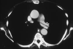 Pulmonary Embolism and Deep Vein Thrombosis (DVT) - CTisus CT Scan