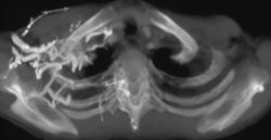 Collaterals With SVC Occlusion - CTisus CT Scan