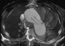 Dissection - CTisus CT Scan