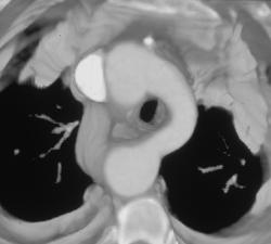 Double Aortic Arch - CTisus CT Scan