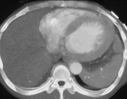 Prominent Myocardium With Endoluminal View - CTisus CT Scan