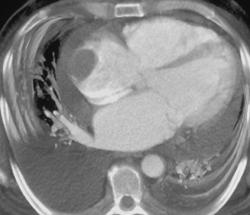 Clot Vs Myxoma in Right Atrium - CTisus CT Scan