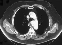 Traumatic Aneurysm - CTisus CT Scan