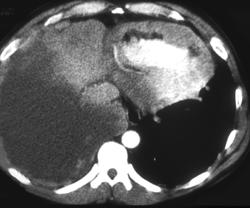 Tumor Infiltrates and Invades the Heart - CTisus CT Scan