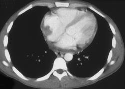 Lymphoma (kidney and Heart) - CTisus CT Scan