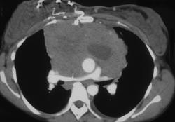 SVC Thrombus Lymphoma With A Hot Spot in the Liver - CTisus CT Scan