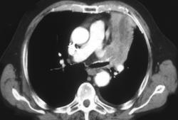 Left Upper Lobe Carcinoma - CTisus CT Scan