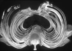 Failed Sternal Repair - CTisus CT Scan