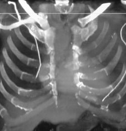 Dehiscence of the Sternum - CTisus CT Scan