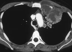 Lymphoma With Internal Mammary Nodes - CTisus CT Scan