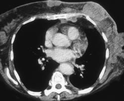 Breast Cancer With Internal Mammary and Axillary Nodes - CTisus CT Scan