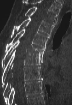 Collapsed Vertebral Body-metastatic Breast Cancer - CTisus CT Scan