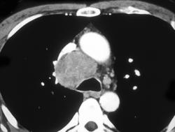 Lymphoma - CTisus CT Scan