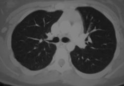 Tracheal Bronchus - CTisus CT Scan