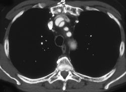 Type A Dissection - CTisus CT Scan