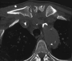 Infection Rt Sternoclavicular Joint - CTisus CT Scan