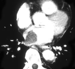 Tumor Thrombus in Left Atrium - CTisus CT Scan