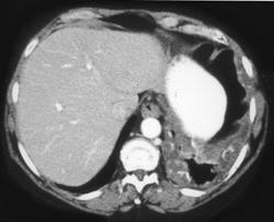 Metastatic Colon Cancer to the Pleura - CTisus CT Scan