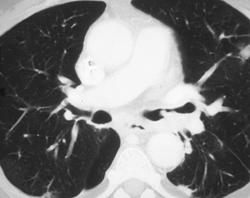 Lung Cancer With Intraluminal Lesion - CTisus CT Scan