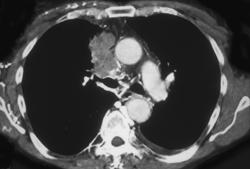 SVC Clot With Collaterals - CTisus CT Scan