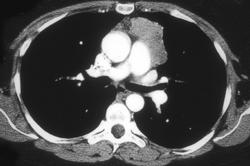 Thymoma - CTisus CT Scan