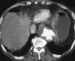 Ulcers in Descending Thoracic Aorta - CTisus CT Scan